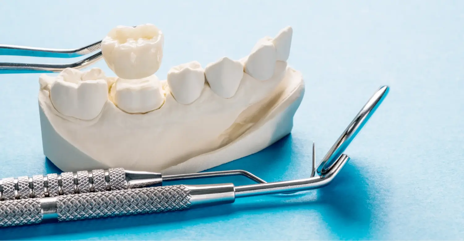 Dental Crowns Cost 2
